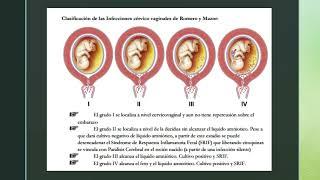 Prevención de infecciones neonatales durante el embarazo