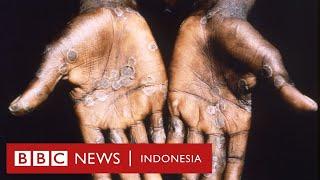 Pengalaman tertular cacar monyet: 'Sangat sakit, cacar tumbuh di selangkangan' - BBC News Indonesia