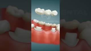 {Use earphone} Dental Bridge [Porcelain] Procedure after extraction  #satisfying