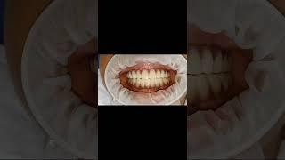 Life changing esthetics with milled PMMA full arch implant teeth set for 45 old female !!