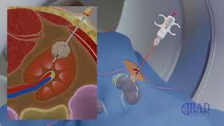 Renal Mass Biopsy (CT guided Kidney Tumor Biopsy)
