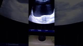 acute cystitis of bladder#cystitis#pregnancyultrasound #pregnancyscan #subscribers#viralvideo#views