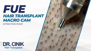 FUE Hair Transplant Macro Cam - Extraction Phase | Hair Transplant | Dr. Emrah Cinik