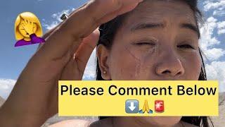 Why My Eye Is Watering || How Do I Stop A Watery Eye ️ || Sunburn  ||