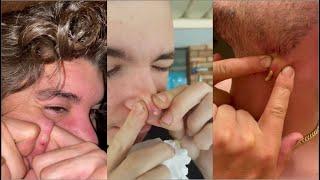 Popping Huge Blackheads and Pimple Popping - Best Pimple Popping Videos 25