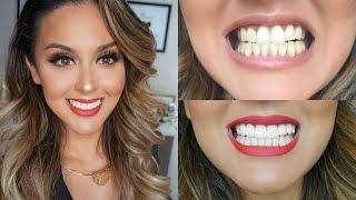 My Teeth Transformation l Veneers Experience