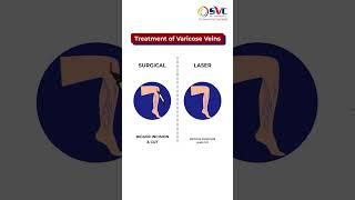 Treatment Of Varicose Veins  - Surgery V/S Laser | वैरिकोज वेन्स