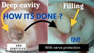 How Deep cavity filling done with nerve protection | pulp capping | Treatment of sensitive cavities