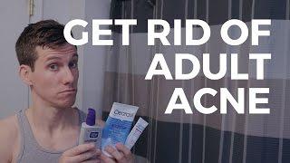 Still Getting Acne In Your 20's and 30's? | How To Treat Adult Acne