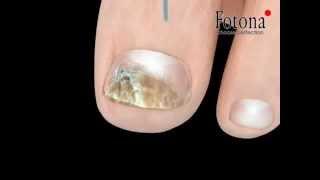 Laser Fungal Nail Infection Treatment with Fotona Laser & rtwskin