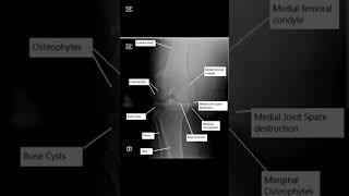 #osteoarthritis #arthritis #xrayclasses #radiology #radiologyresidency #radiologycareer #radiology