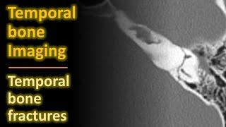 Temporal Bone Imaging - Temporal Bone Fractures