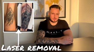 Laser tattoo removal (cover ups/process and overall experience)