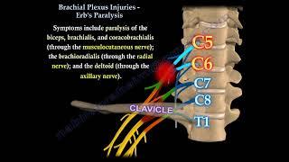 Brachial Plexus Injuries: Erb’s & Klumpke’s Palsy