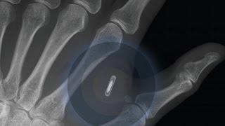 Dangerous Things RFID-NFC-Implantat xNT