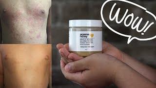 GET RID OF YOUR ECZEMA / ECZEMA HONEY HEALING CREAM