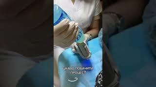 Цікаво подивитися процес SMAS лифтинга?