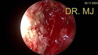 ROUND CELL TUMOUR OF NASAL CAVITY- FESS- ENT DOCTOR INDIA, ENT SURGEON INDIA, ENT DOCTOR IN MUMBAI