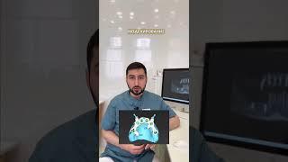 Продолжая вчерашнюю тему об имплантации при полном отсутствии зубов, хотим поделиться с вами кейсом