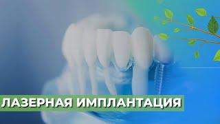 Лазерная имплантация зубов ️
