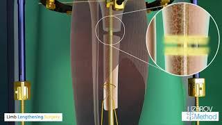 Limb Lengthening Surgery - Ilizarov Method - LiveLifeTaller.Com