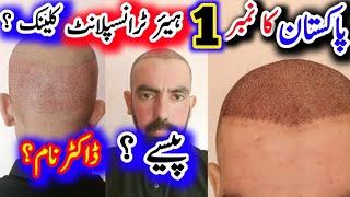 TOP 1 Hair Transplant Clinic in Pakistan ||Best Hair Transplant Center in Pakistan || Price ||