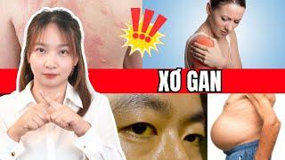7 DẤU HIỆU CẢNH BÁO XƠ GAN "GIAI ĐOẠN CUỐI"| Bác Sĩ Hoa