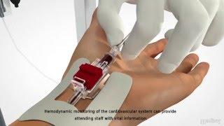 MEDBAR - Arterial Cannula