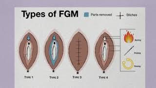 Female Genital Mutilation