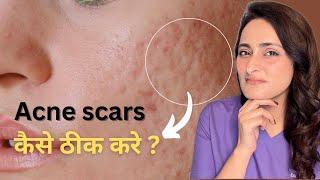 Acne Scar | kaise hataye | Laser, Derma roller | hindi | Tvacha ke doctor