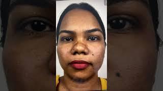 Thick skinned flat ethnic nose correction by surgery