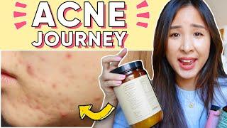 How I Used Food, Supplements & Nutrition to CLEAR My Acne, NATURALLY 