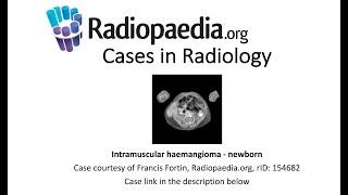 Intramuscular haemangioma - newborn (Radiopaedia.org) Cases in Radiology