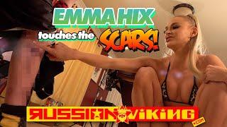 Emma Hix touches Ivan's leg scars!