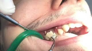 Scaling Gigi Penghapusan Plak