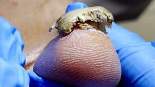 The front of the toenail is damaged, cut off the fungus【Pedicure Master Lin Jun】