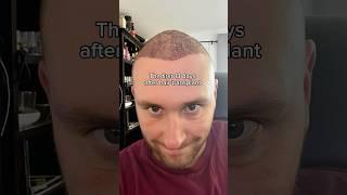 Hair Transplant Journey: 13 Days of SHOCKING Changes!