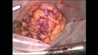 Laparoscopic Cystoprostatectomy & Pelvic Lymphadenectomy