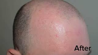 Repairing prior unnatural hair transplants: FUE removal, and hairline excision.