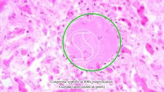 Congenital Syphilis under the microscope with HE stain