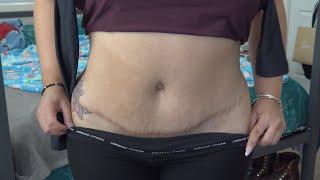 My Tummy Tuck Surgery Scars 2 Years Later