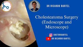 Cholesteatoma Surgery (Endoscopic and Microscopic)