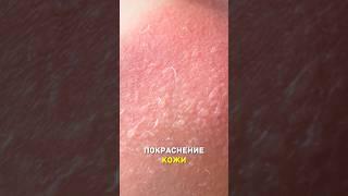 Просто о солнечных ожогах #shorts