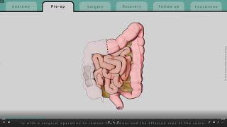 Right Hemicolectomy explained | What patients can expect | TVASurg