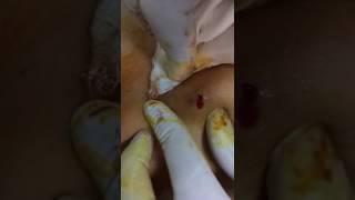 Hematom boşaltma / Hematoma drainage