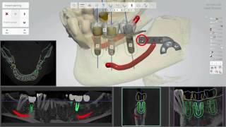 Step 6   Implant Planning