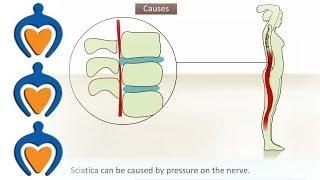 Sciatica - What is it and how is it treated?