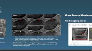 Regenexx Stem Cell Procedure Overview Webinar with Dr Centeno