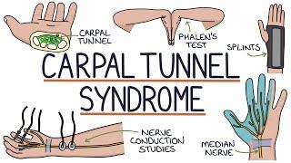 Understanding Carpal Tunnel Syndrome