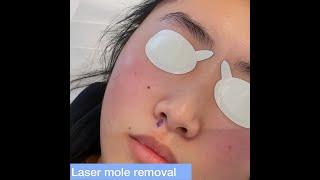 Laser Mole Removal - London Skin Clinic